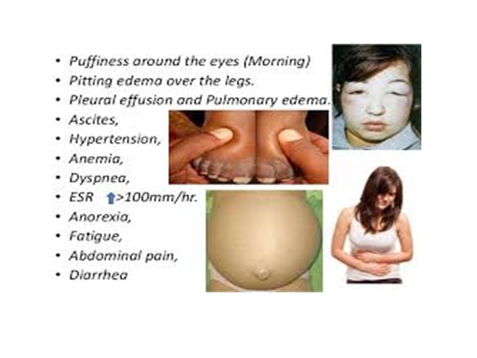 Nephrotic Syndrome Signs and Symptoms Management Nursing Care